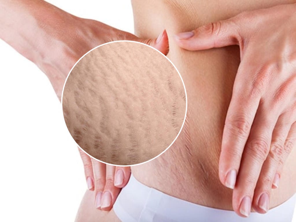 تغییر رنگ و روند بهبودی ترک پوستی